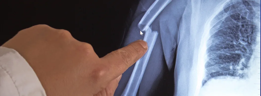 Injury Broken Bones